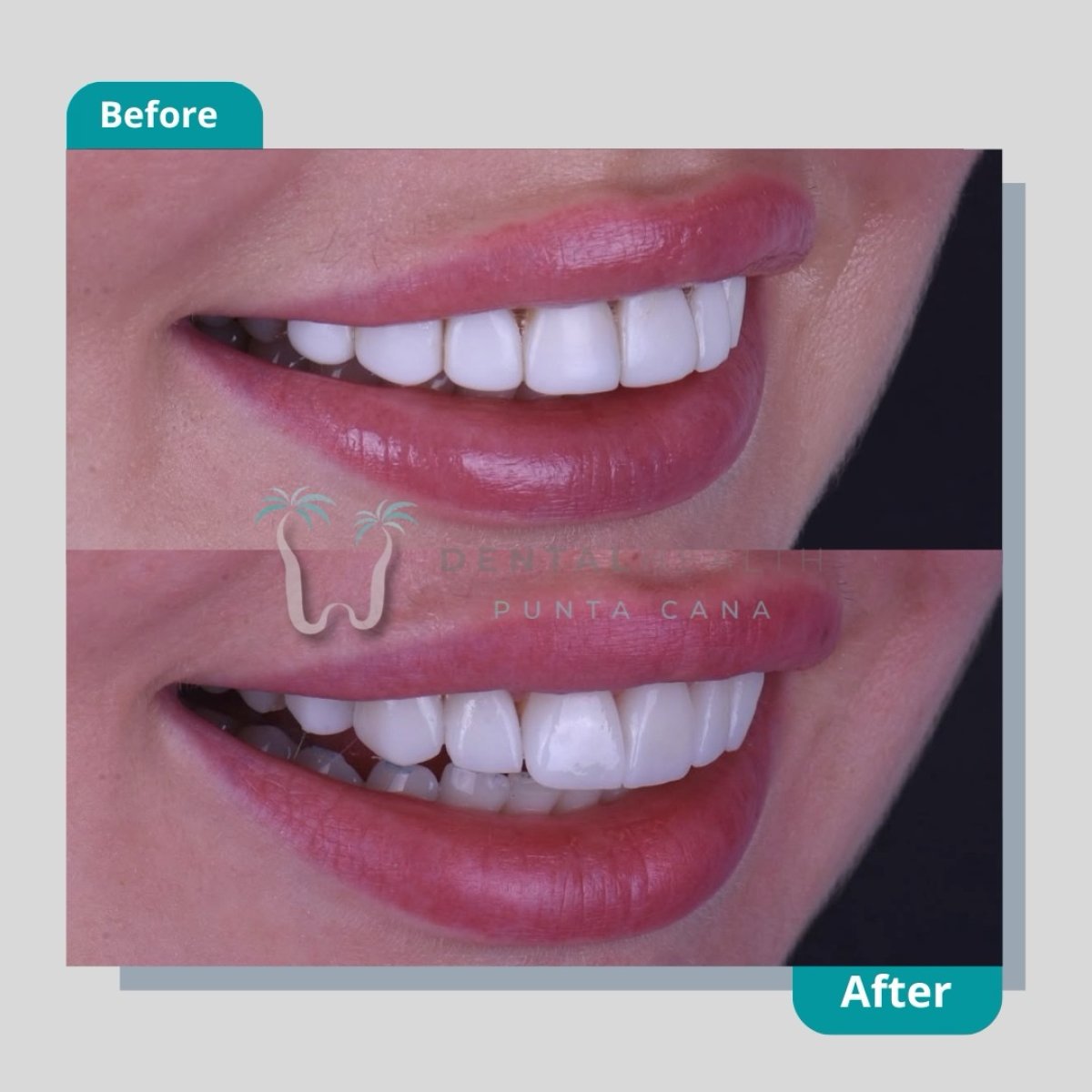 نتيجة الفينير قبل وبعد في Dental Health Punta Cana – تحول الابتسامة