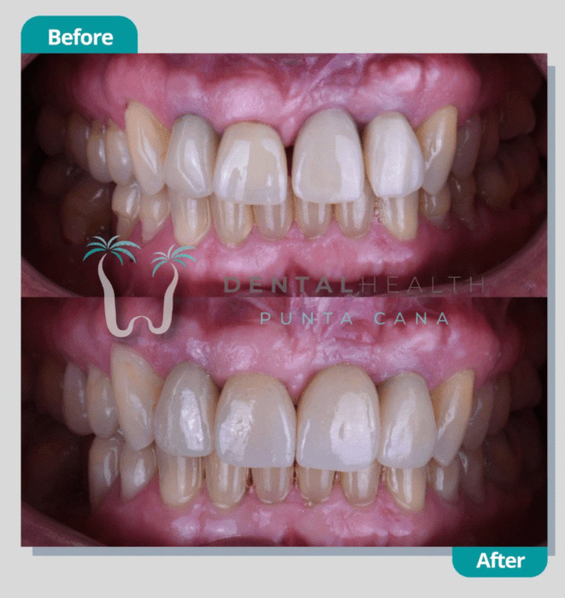 Результаты отбеливания зубов до и после в Dental Health Punta Cana – белоснежная улыбка