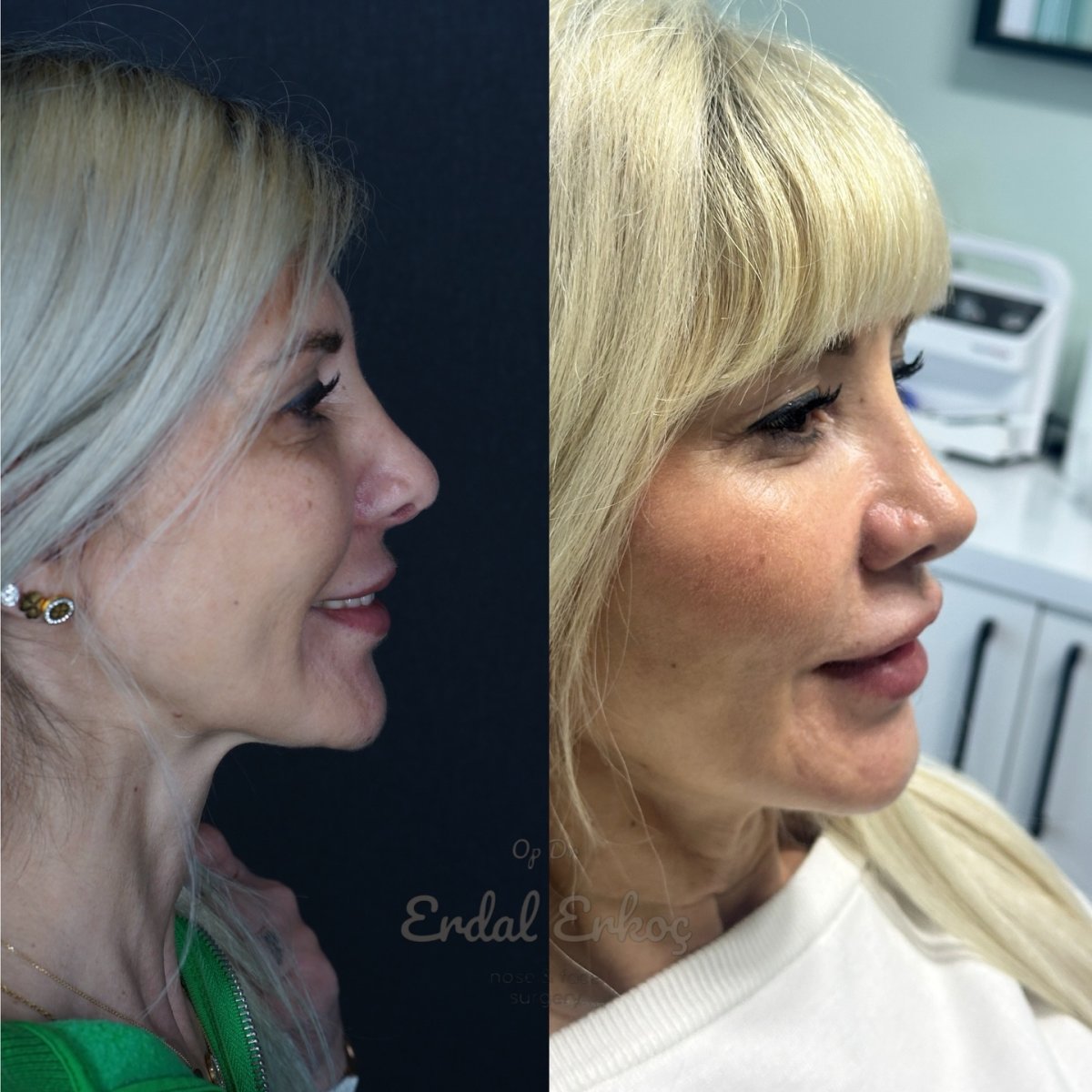 نتائج عملية تجميل الأنف قبل وبعد في عيادة إردال إركوش، تحسين شكل الأنف