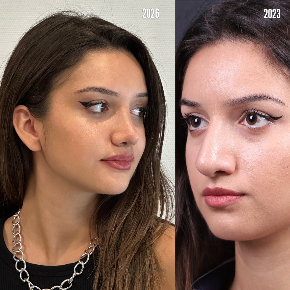 Before and after rhinoplasty results, nose reshaping and profile improvement in female patient