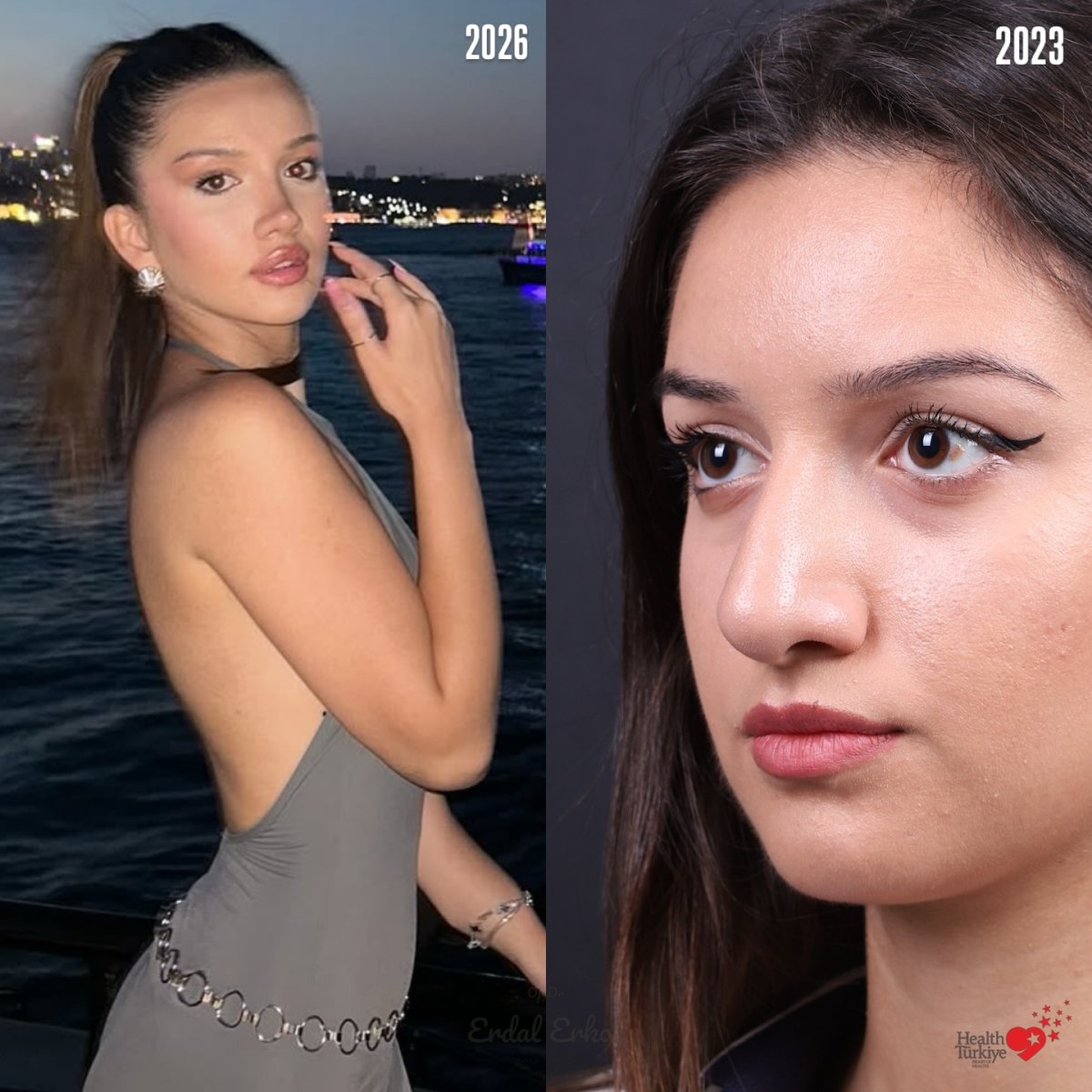 نتائج عملية تجميل الأنف قبل وبعد في Health Türkiye، تحسين واضح لشكل الأنف