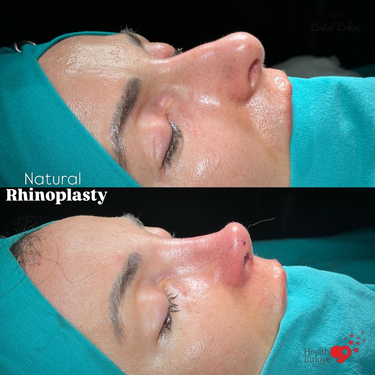 Before and after rhinoplasty results at Health Turkiye, natural nose reshaping outcome