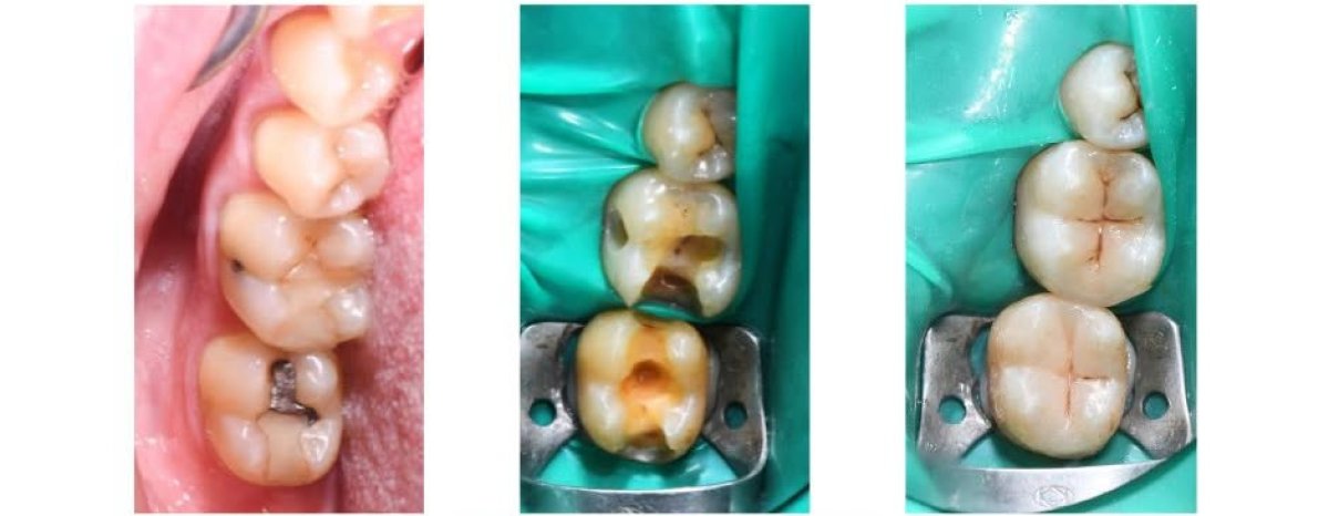 Resultados de restauración dental (bonding) antes y después – reparación de caries y aspecto natural