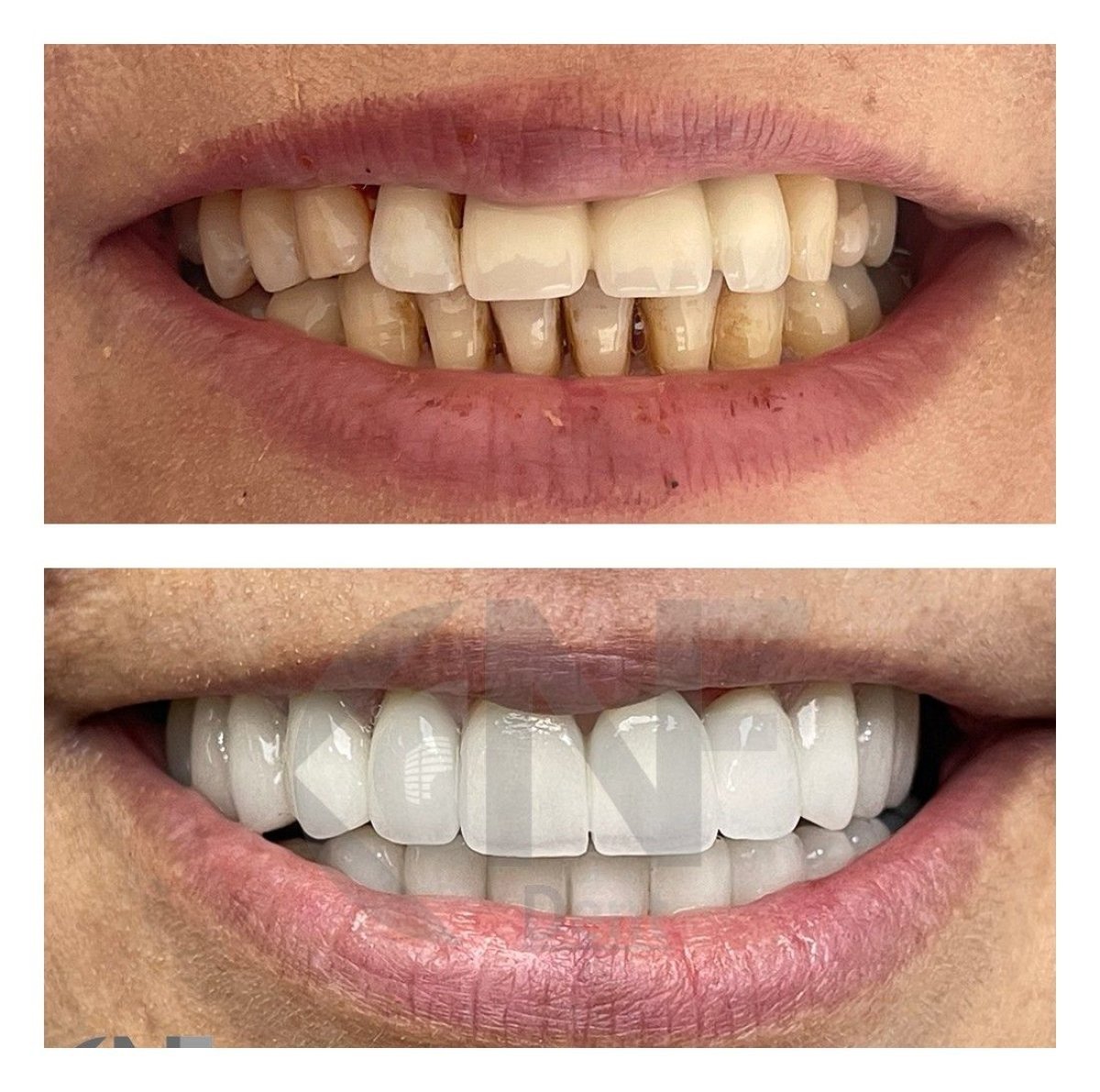 نتائج قبل وبعد زراعة الأسنان في Nifa Dent International – ابتسامة بيضاء مستعادة