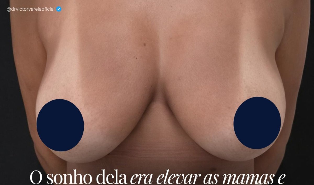 صورة قبل عملية رفع الثدي في العيادة – ترهل الثدي قبل عملية الماستوبكسي النتيجة