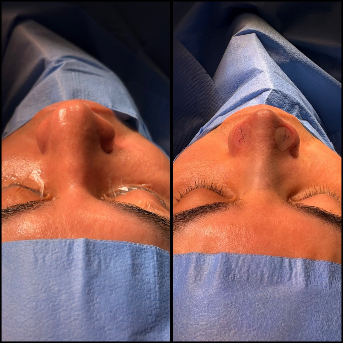 نتائج عملية تجميل الأنف قبل وبعد، إعادة تشكيل الأنف مع تغييرات جراحية واضحة