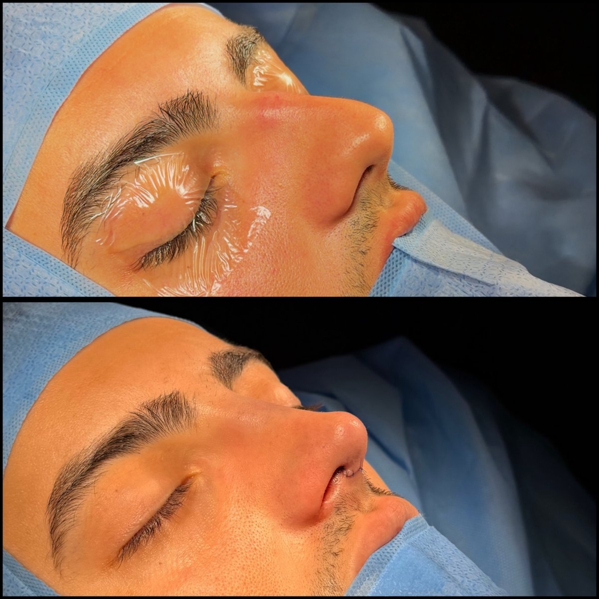 نتائج عملية تجميل الأنف قبل وبعد، إعادة تشكيل واضحة وتحسين مظهر الأنف