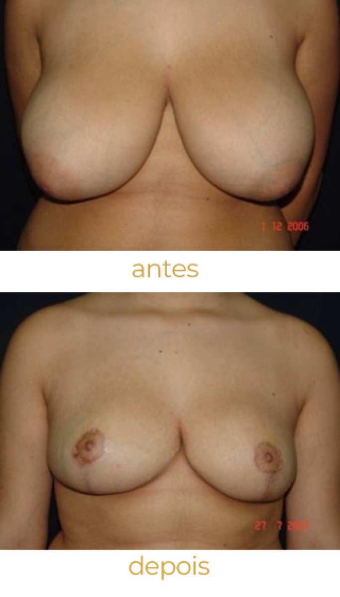 Before and after breast reduction results – improved breast shape and size after surgery
