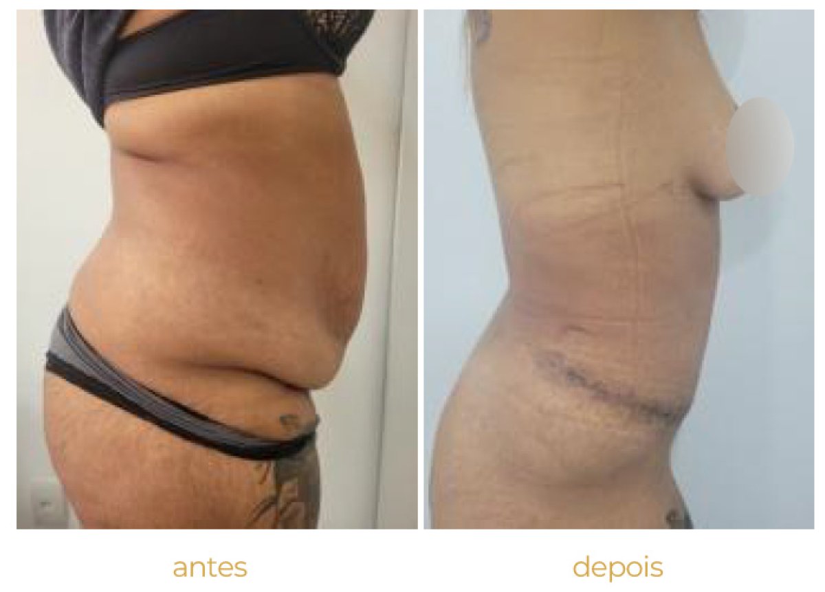 Before and after tummy tuck results – visible abdominal contour improvement after surgery