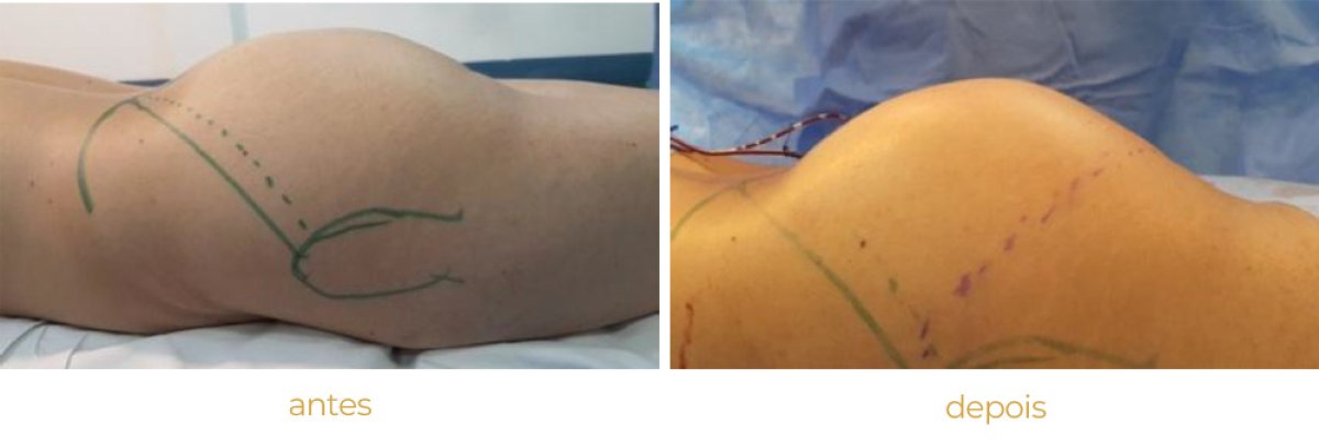Before and after butt implants results – enhanced gluteal contour after procedure