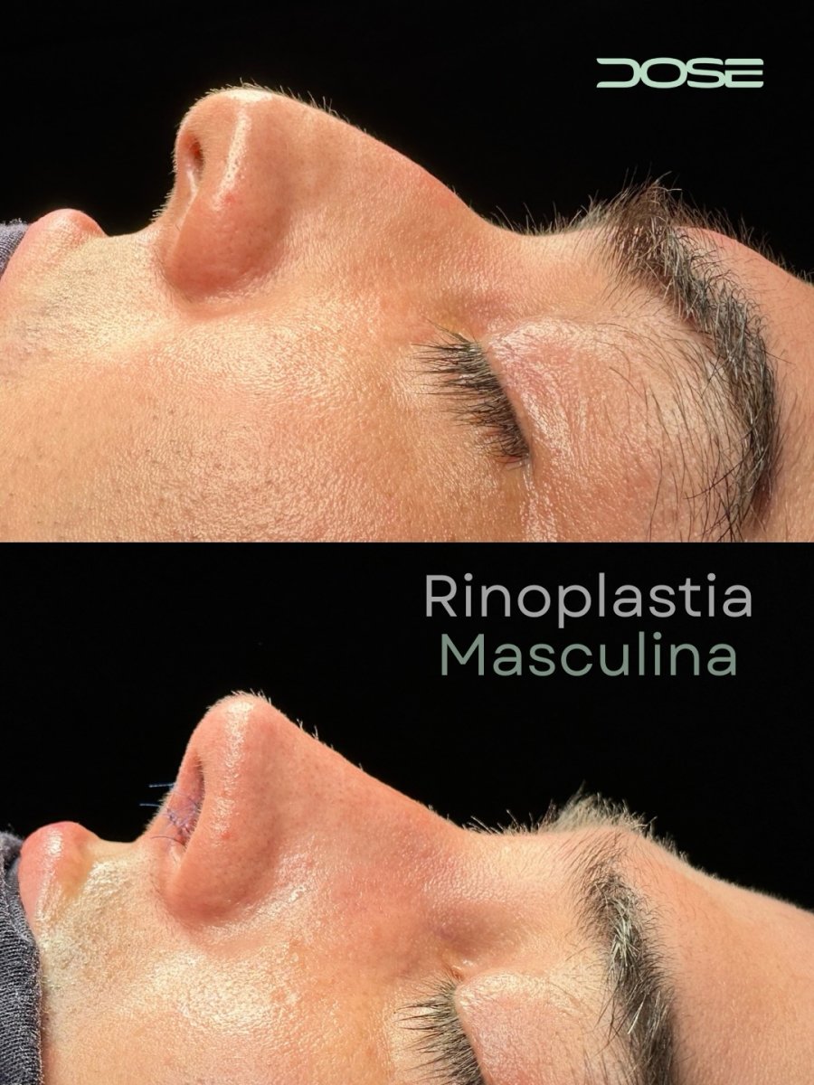 Before and after male rhinoplasty results at DOSE clinic, improved nose shape profile