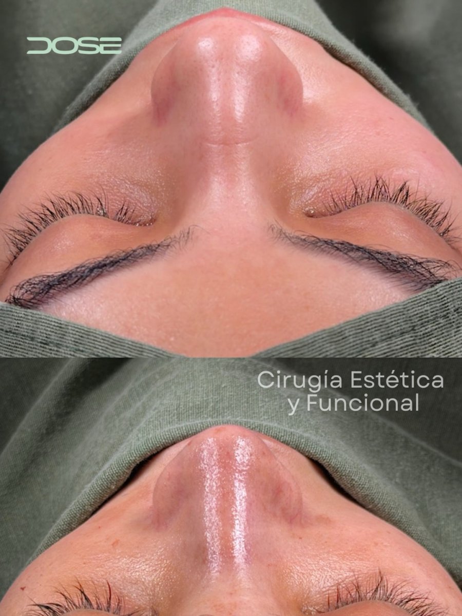 Before and after rhinoplasty results at DOSE clinic, nose reshaping with natural outcome