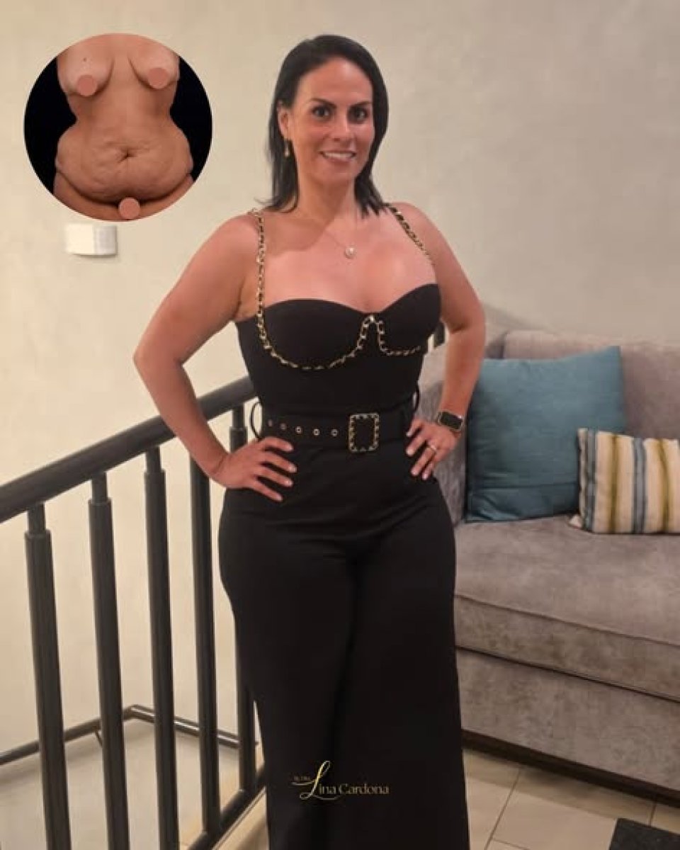 Mommy makeover before and after results – body contour improvement and firmer abdomen