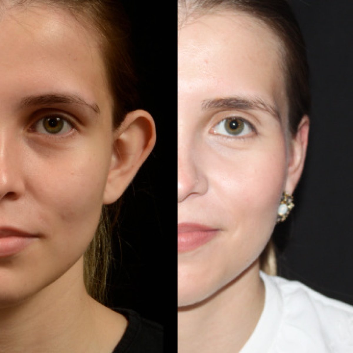 Before and after otoplasty results – ear reshaping surgery for improved ear appearance