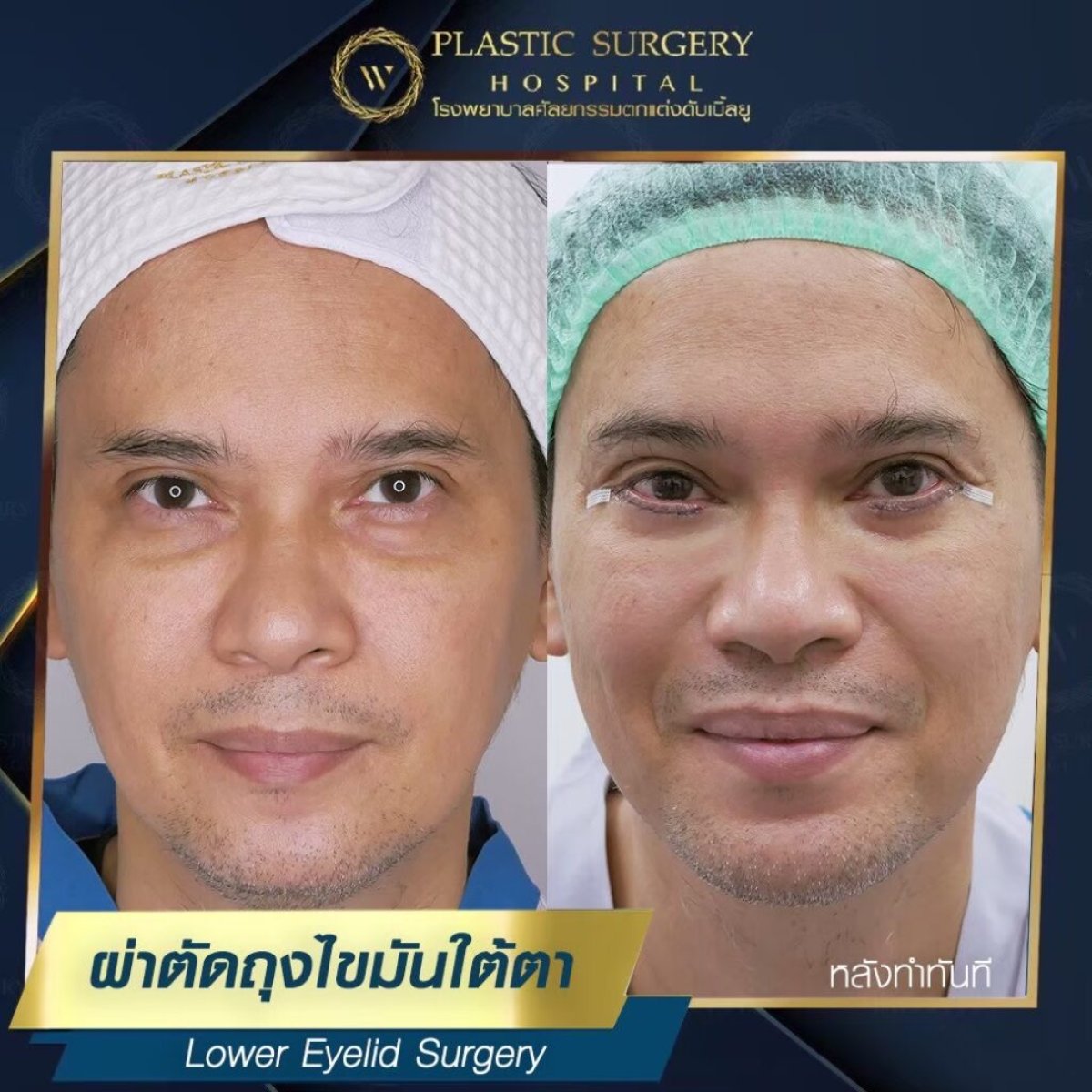 نتائج جراحة الجفن السفلي قبل وبعد في Plastic Surgery Hospital، تقليل الانتفاخات