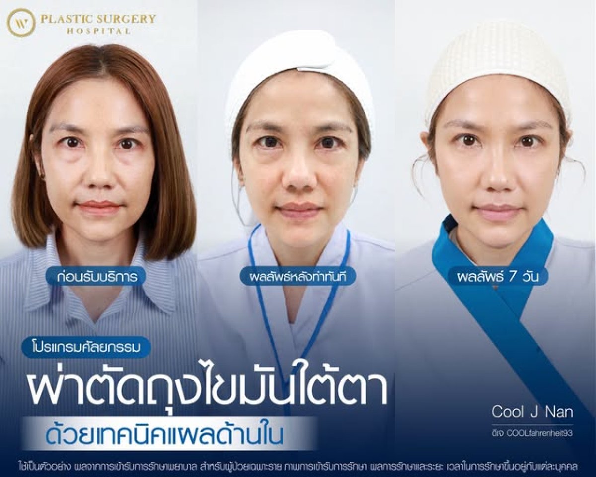 نتائج إزالة دهون تحت العين قبل وبعد في Plastic Surgery Hospital، تحسين منطقة العين
