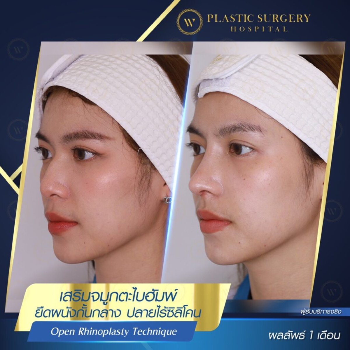 نتائج عملية تجميل الأنف المفتوحة في W Plastic Surgery Hospital بعد شهر واحد