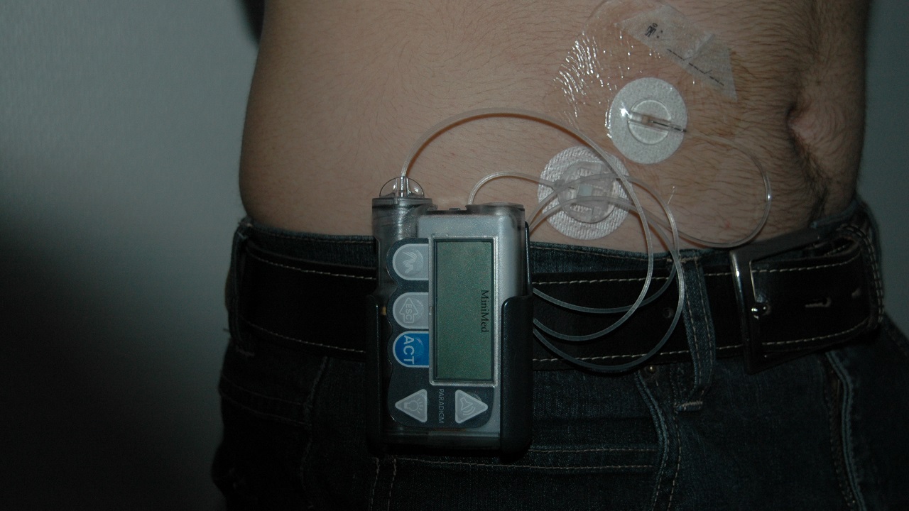 مرض السكري, صحة, طب, أنسولين, مضخة أنسولين