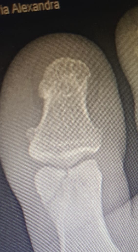 Fracture of the big toe.jpg