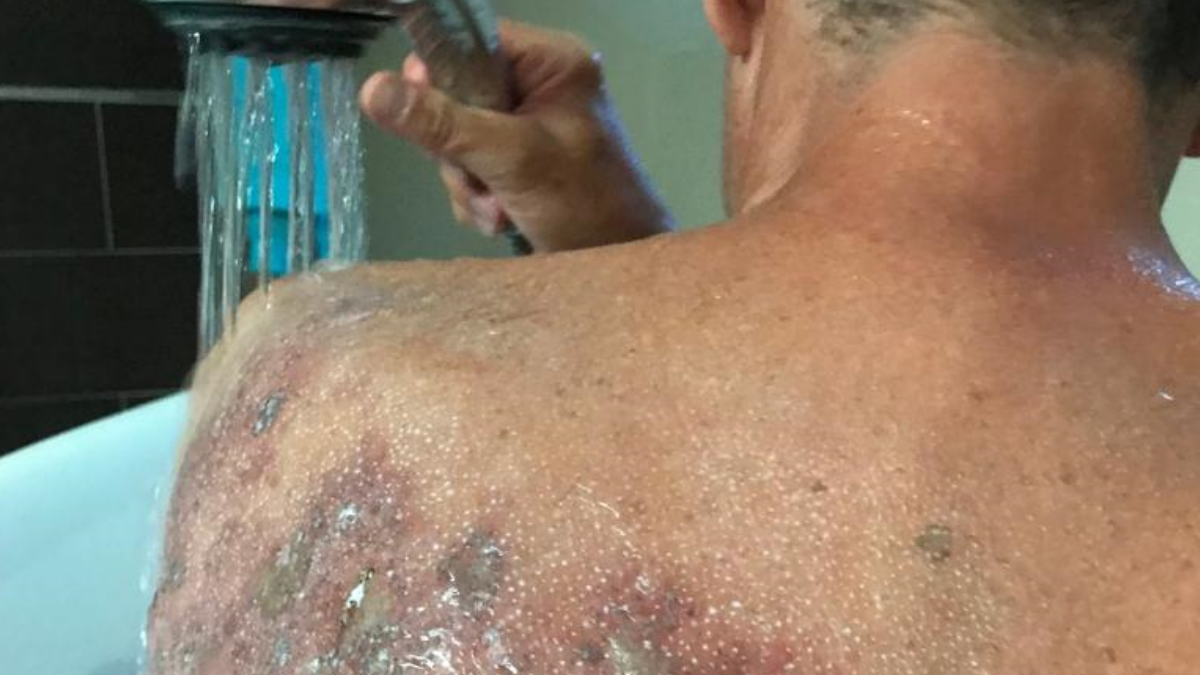 Carsten leidet unter einer Gürtelrose