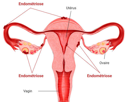 endométriose