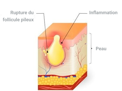 Photos et étapes de l'acné