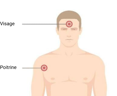 Acné : causes, facteurs de risque et rôle des hormones
