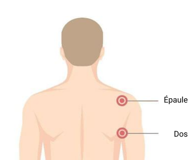 Acné : causes, facteurs de risque et rôle des hormones