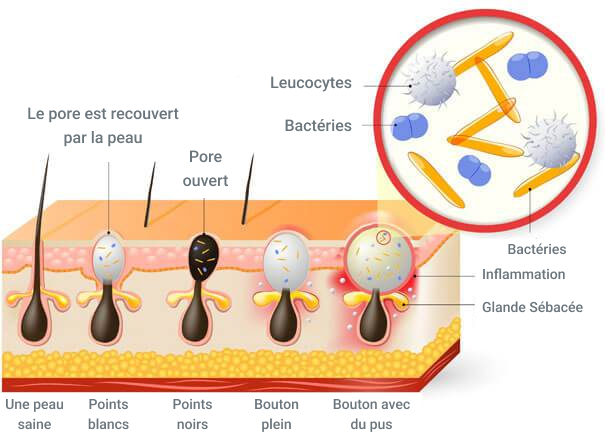 Acné associée à des perturbations hormonales