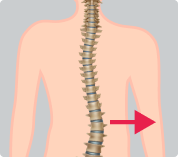 Dextroscoliose