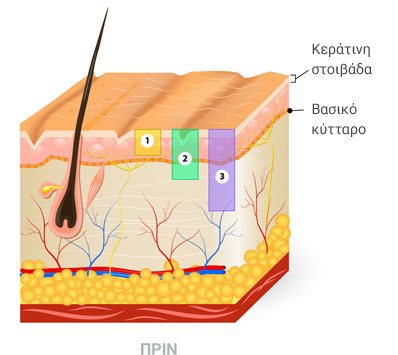 Χημικό peeling πριν