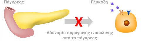 Diavitis typou 1
