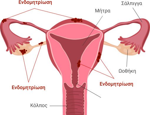 Ενδομητρίωση
