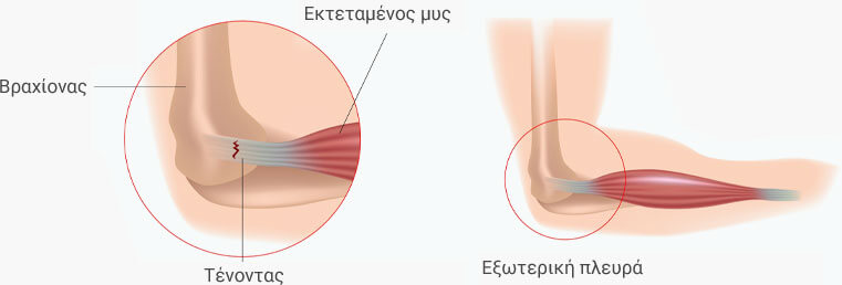 αγκώνας των τενιστών
