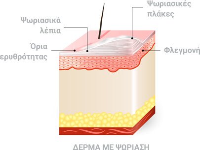 Δέρμα με ψωρίαση
