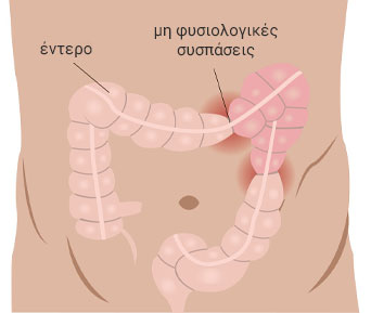 Σύνδρομο ευερέθιστου εντέρου