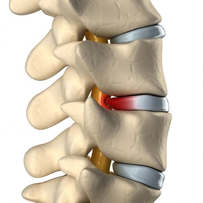 Spinal cord under pressure shows why a hard surface mattress, like a hard buckwheat mattress might be a solution