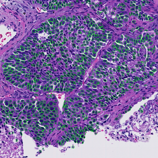 tumor_cell_detection512.png tumor_cell_detection512.png