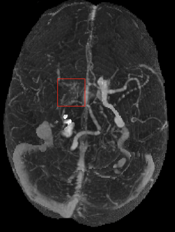 ica occlusion.png ica occlusion.png