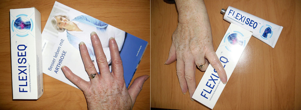 kleine Finger vor und nach Behandlung mit Flexiseq© Mitglied kleine Finger vor und nach Behandlung mit Flexiseq© Mitglied