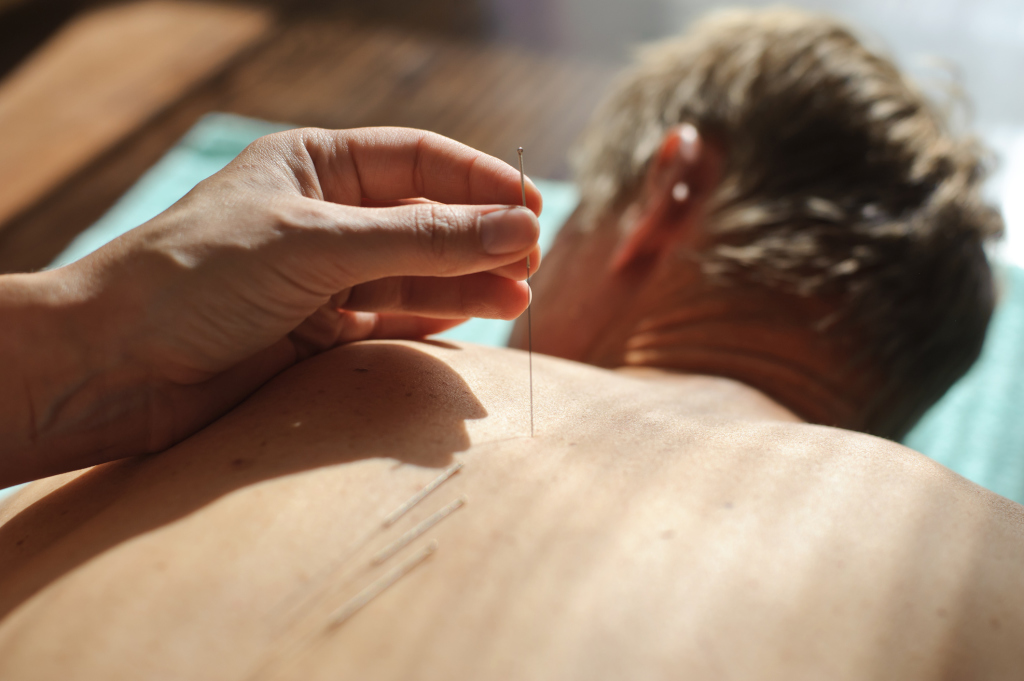 Akupunkturbehandlung Rücken Akupunkturbehandlung Rücken