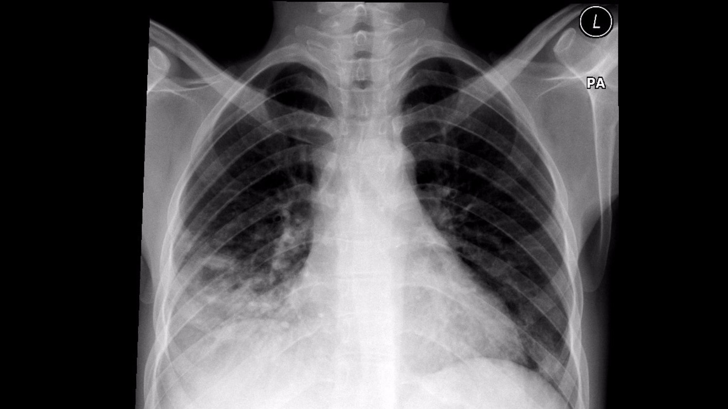 lobar pneumonia radiologyzone org