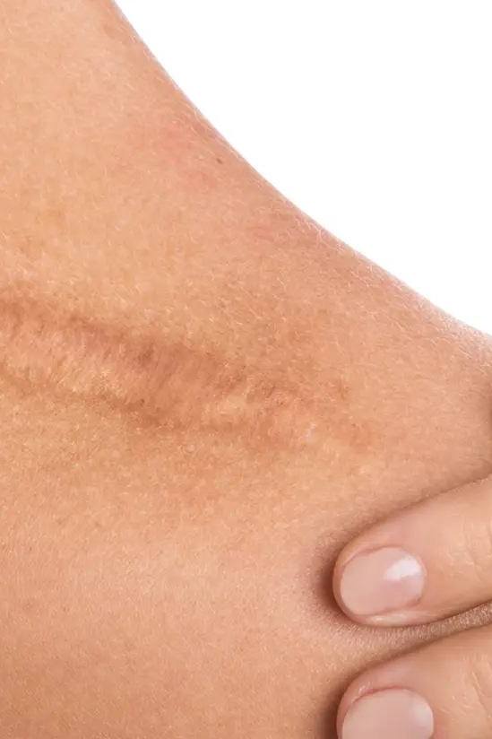 Dermadrop scar treatment Matcha ♀ ♂
