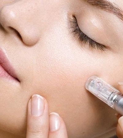 Ameson Micro-Needling