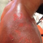 Hendricks_back_burns