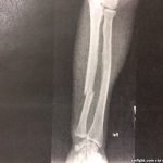 holly-holm-broken-arm