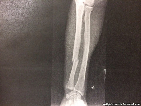 holly-holm-broken-arm