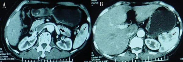 Gastrointestinal tuberkulos