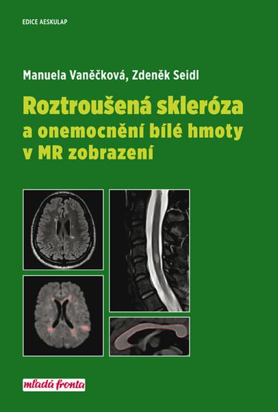 Roztroušená skleróza a onemocnění bílé hmoty v MR zobrazení - 978-80-204-4687-9
