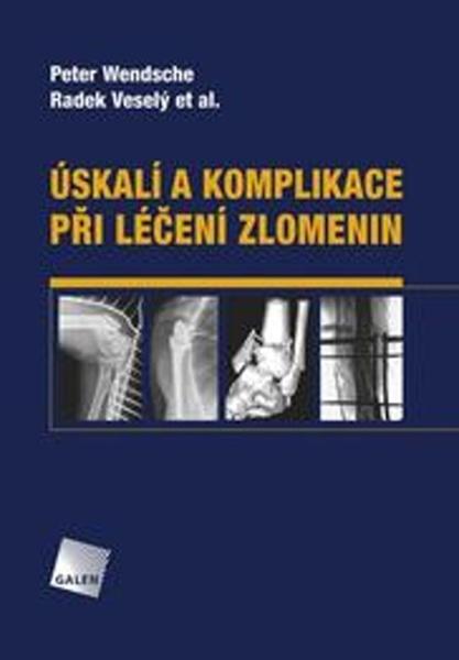 Úskalí a komplikace při léčení zlomenin - Radek Veselý - 978-80-7492-393-7